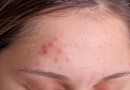 What are the best treatments for acne?