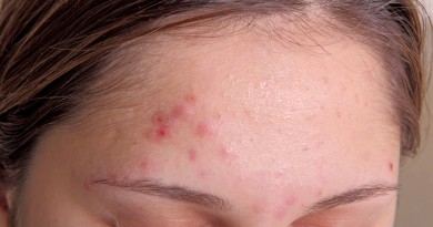 What are the best treatments for acne?