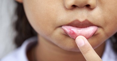 Canker sores: a problem that torments many people