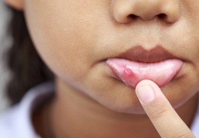 Canker sores: a problem that torments many people